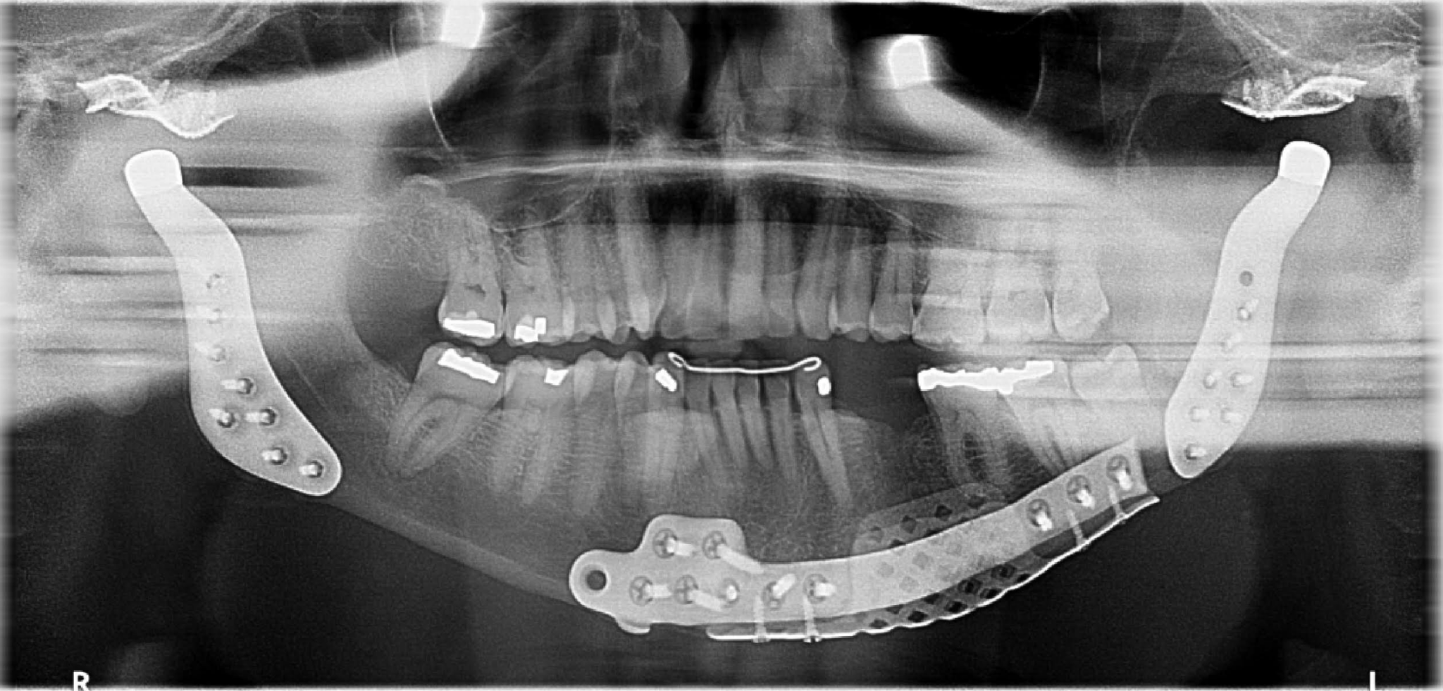 Facial Trauma & Injury | Associated Oral & Maxillofacial Surgeons